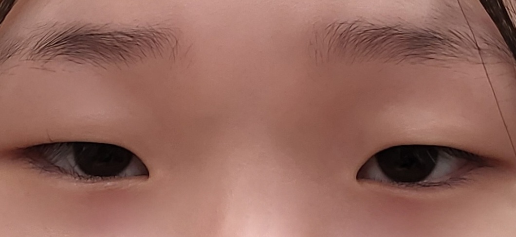 쌍꺼풀(절개) 후기