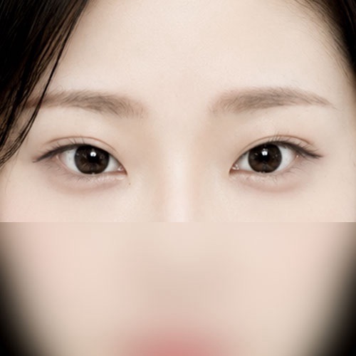 밑트임 후기