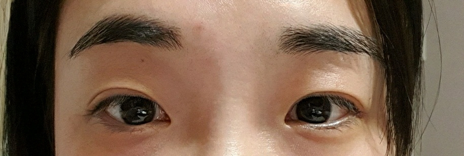 쌍꺼풀(절개) 후기