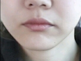 입꼬리성형 후기