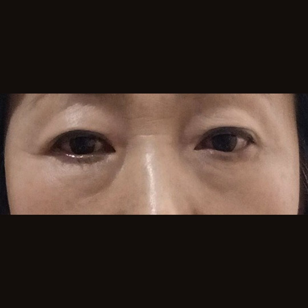 눈밑지방재배치 후기