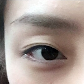 쌍꺼풀(절개) 후기