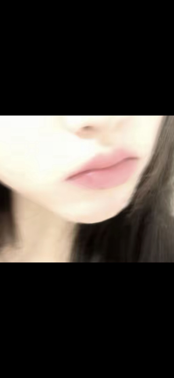 입꼬리성형 후기