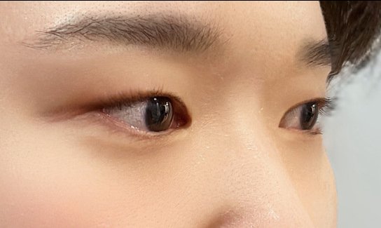 쌍꺼풀(절개) 후기