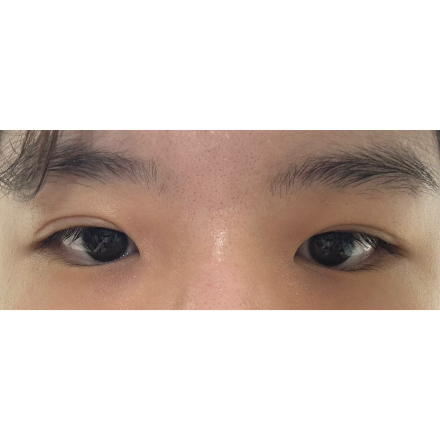 눈재수술 후기