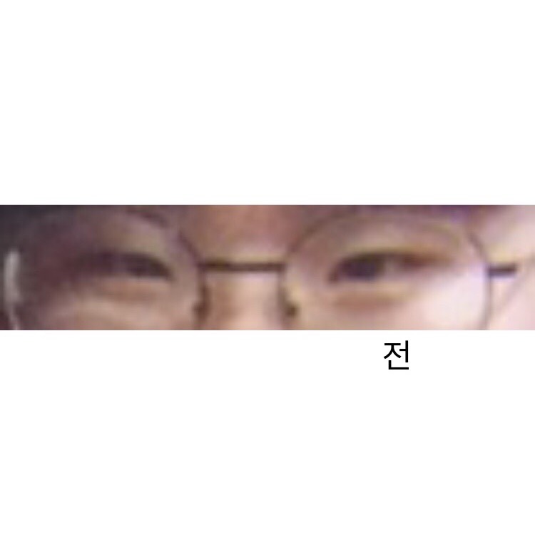 쌍꺼풀(절개) 후기