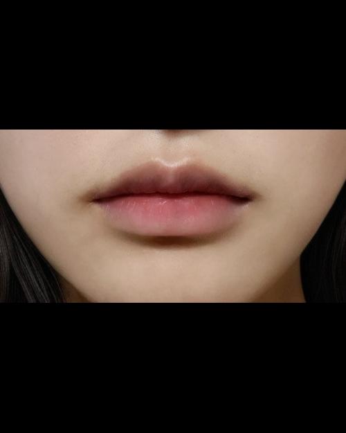큐피트라인성형 후기