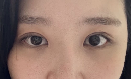 눈재수술 후기