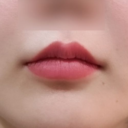 입꼬리성형 후기