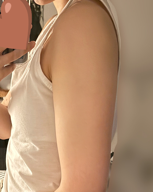 팔지방흡입 후기
