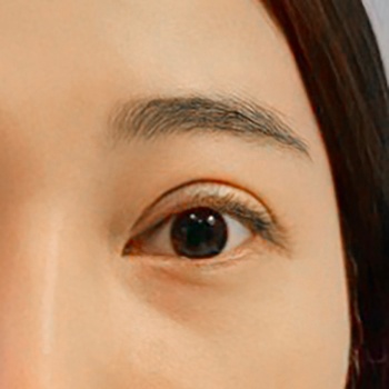 눈재수술 후기