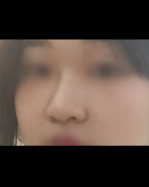 콧대(보형물) 후기