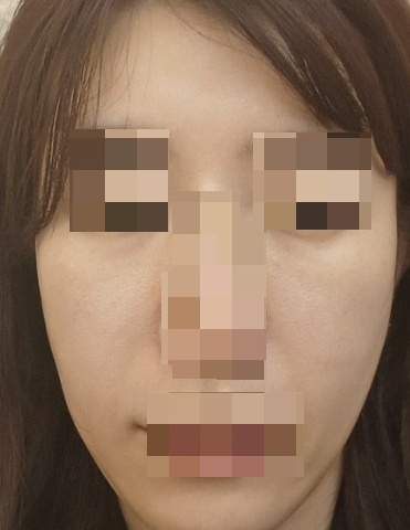 온다리프팅 후기