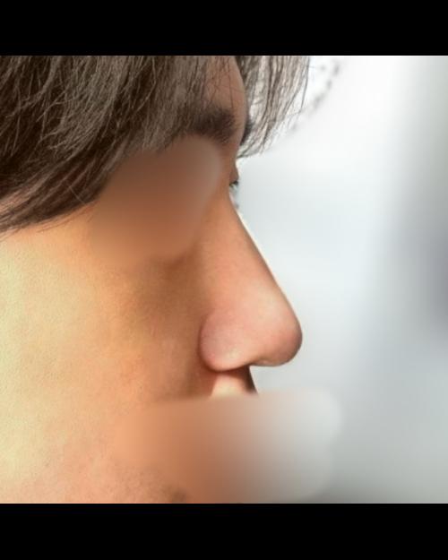 코재수술 후기