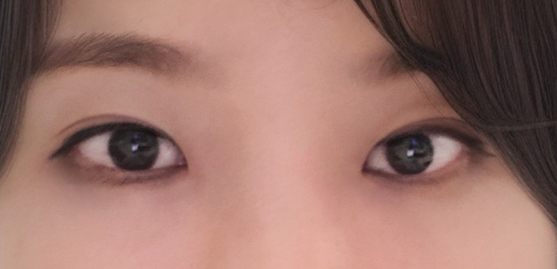 눈재수술 후기