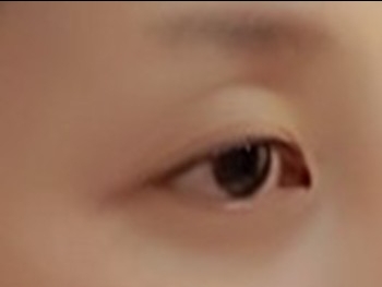 쌍꺼풀(자연유착) 후기