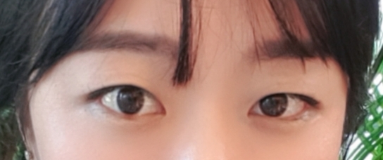 쌍꺼풀(매몰) 후기