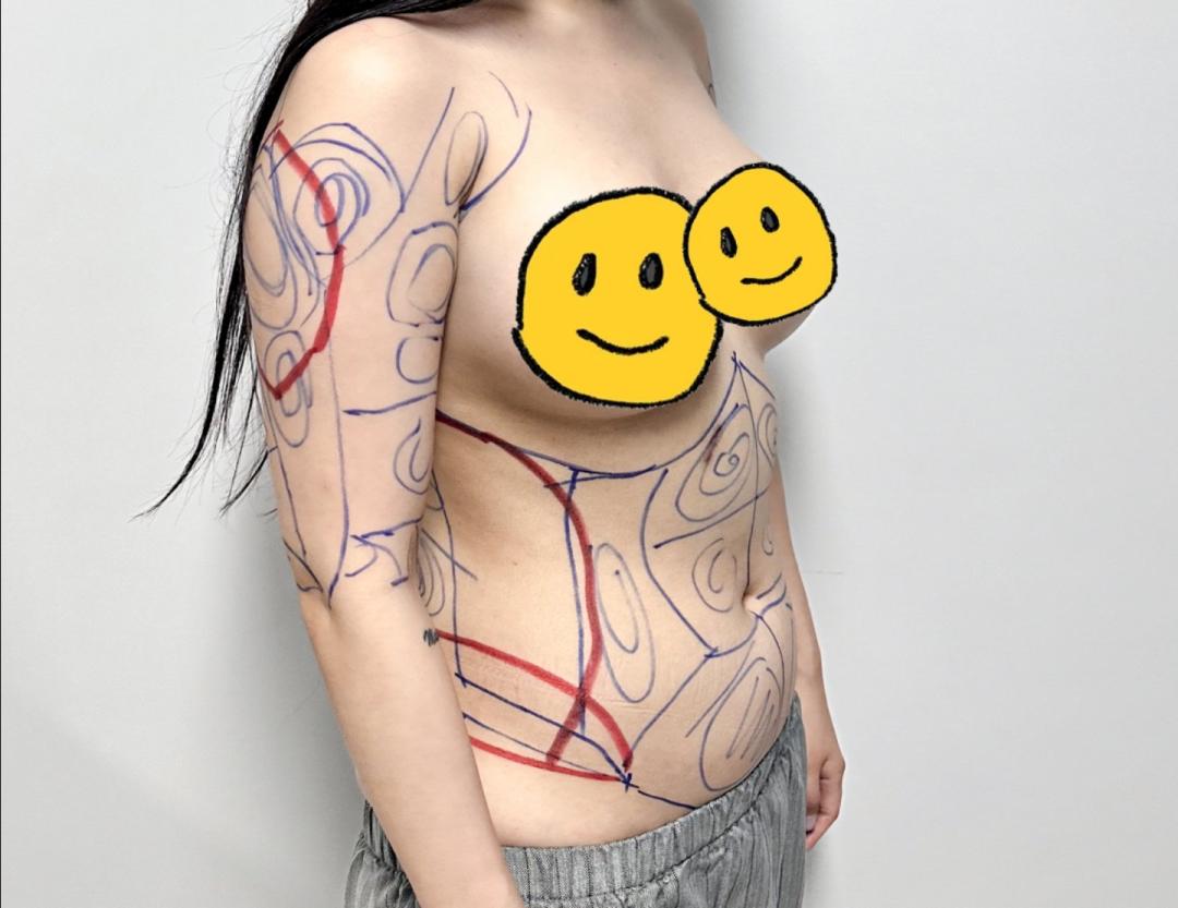 팔지방흡입 후기