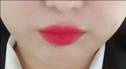 입꼬리성형 후기