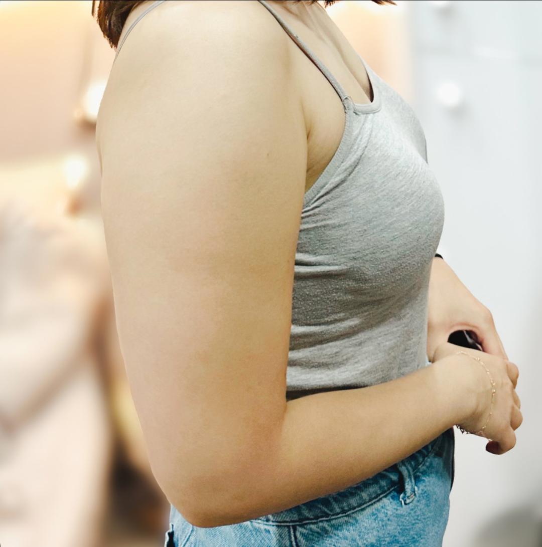 팔지방흡입 후기