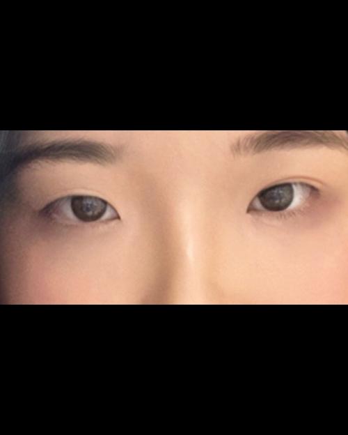 밑트임 후기