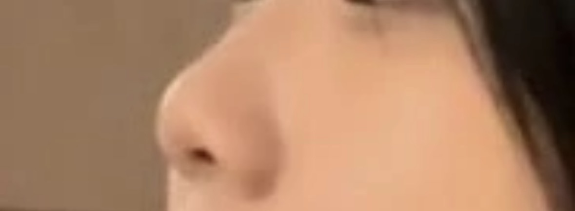 복코성형 후기