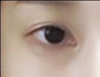 눈재수술 후기