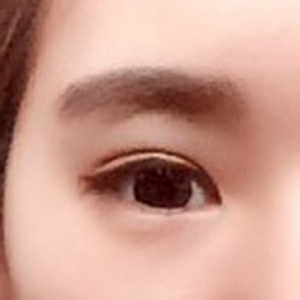 눈재수술 후기