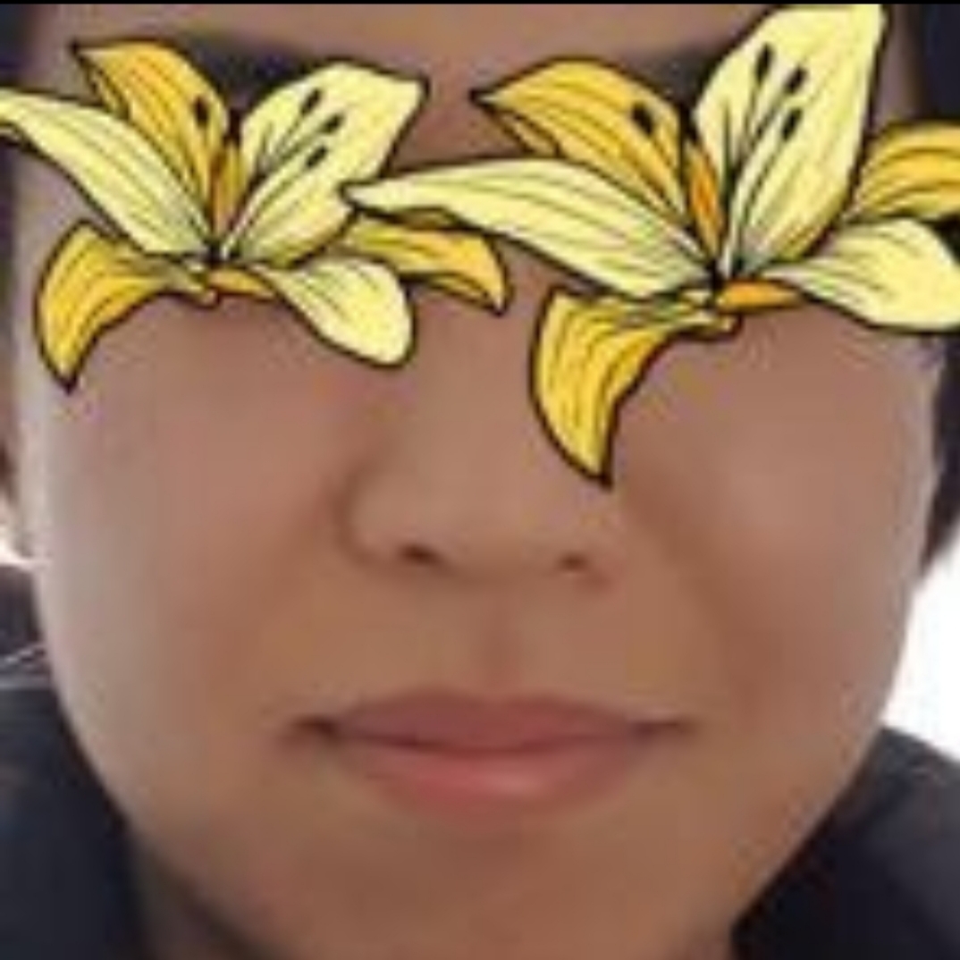 입꼬리성형 후기