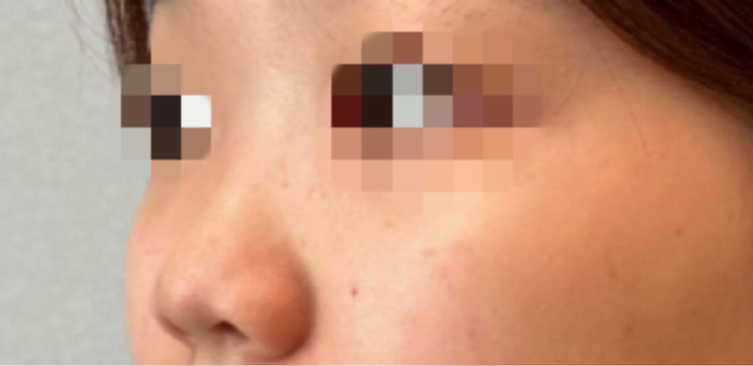 콧대(보형물) 후기