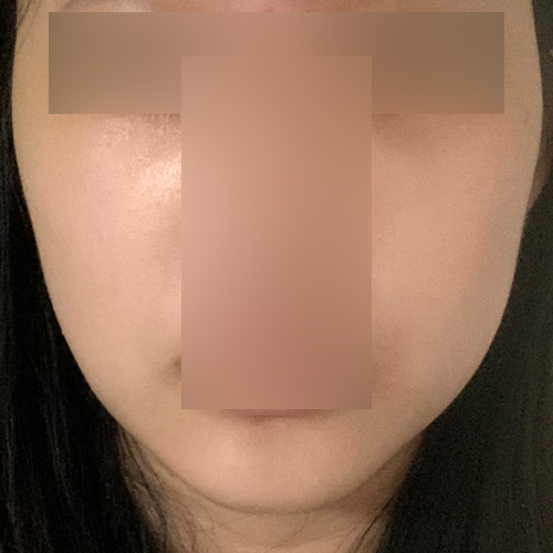 실리프팅 후기