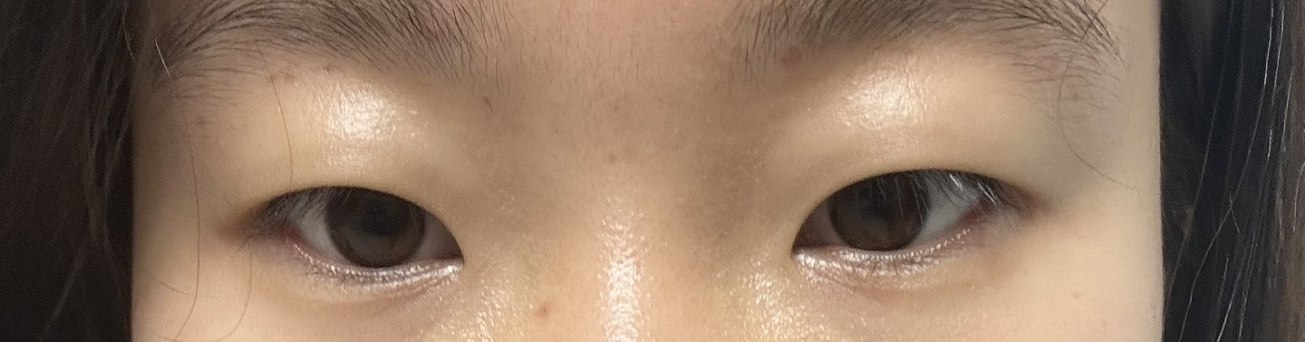 쌍꺼풀(절개) 후기