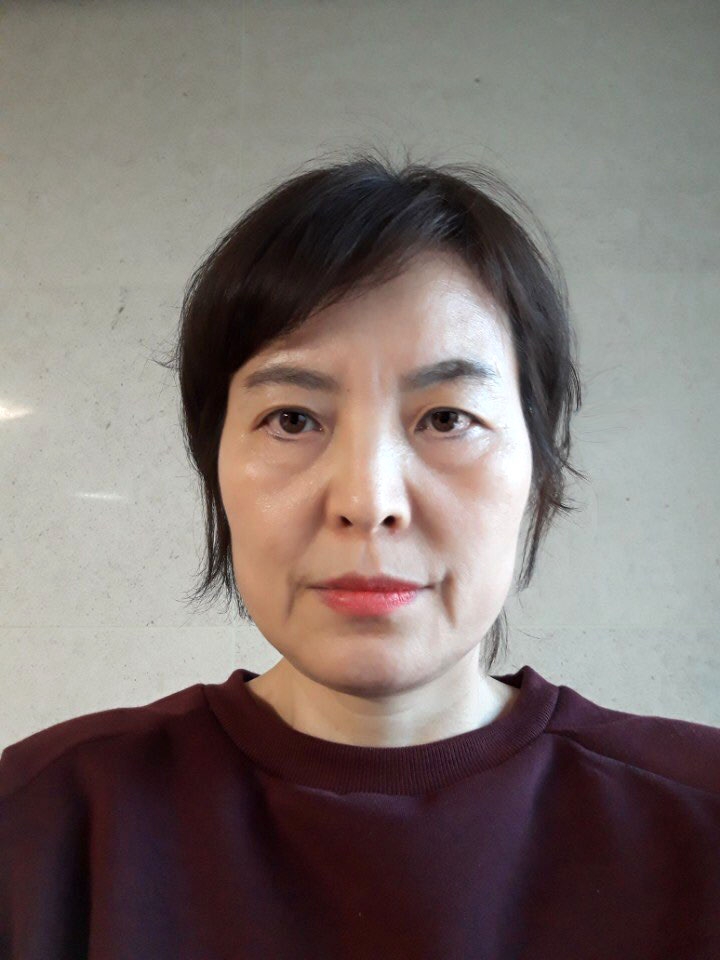 앞광대지방이식 후기
