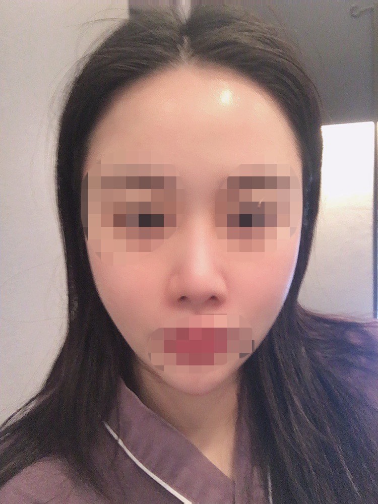 코재수술 후기