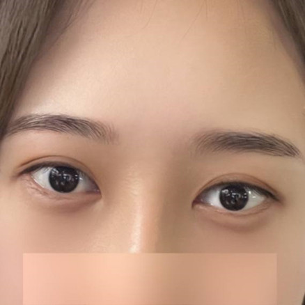눈재수술 후기
