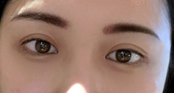 눈재수술 후기