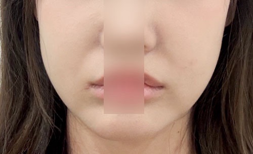 실리프팅 후기
