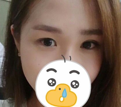눈재수술 후기
