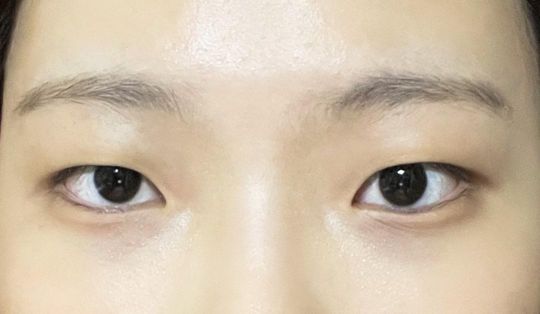 쌍꺼풀(절개) 후기