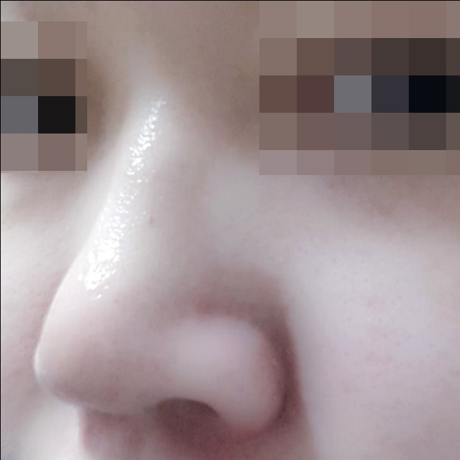 콧볼축소 후기