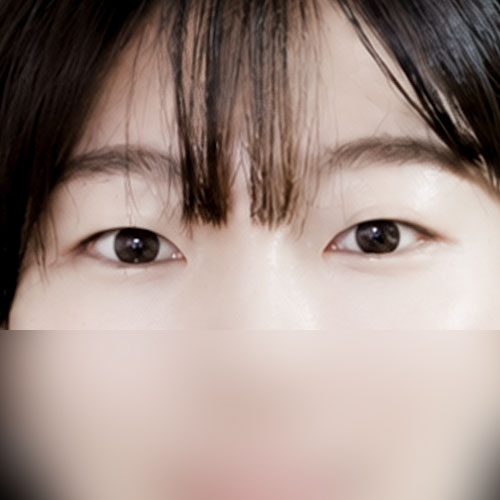 쌍꺼풀(자연유착) 후기