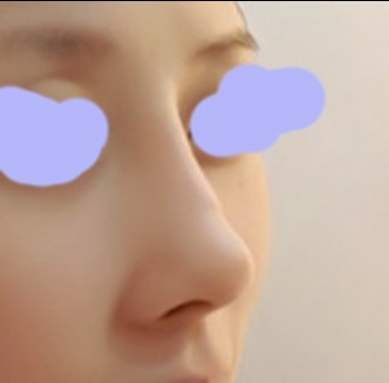 코재수술 후기