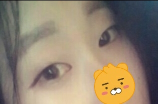 쌍꺼풀(절개) 후기