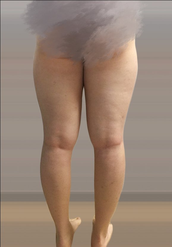 허벅지지방흡입 후기