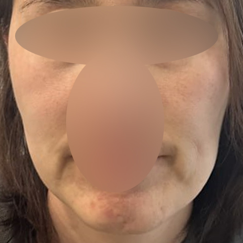 실리프팅 후기