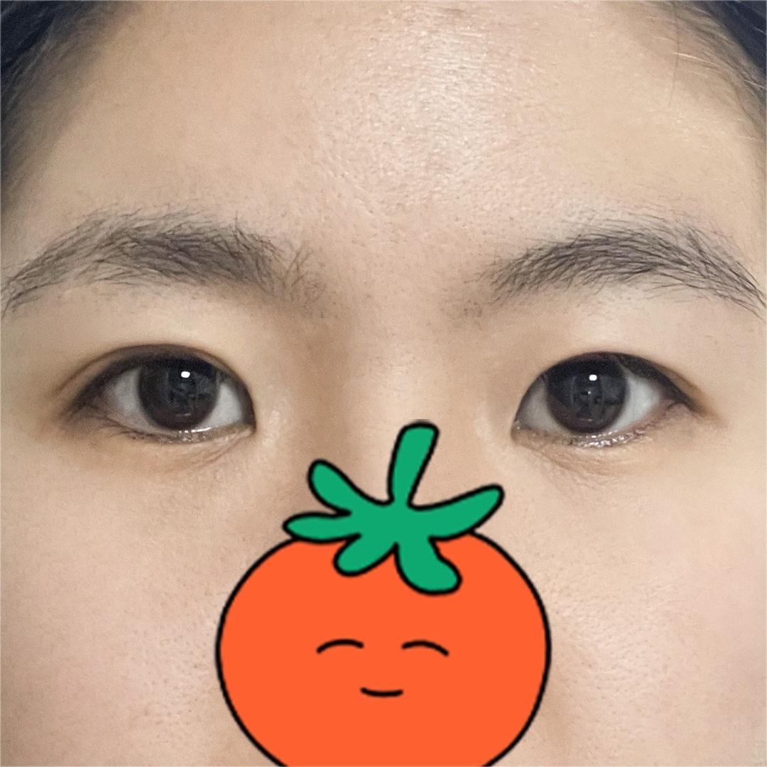 밑트임 후기