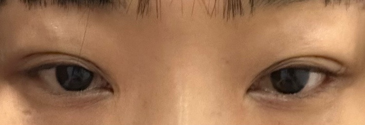 밑트임 후기
