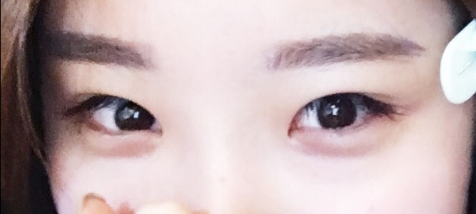 눈재수술 후기