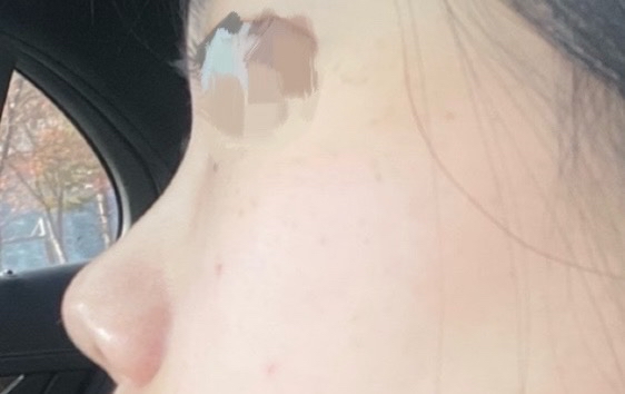 콧대(보형물) 후기