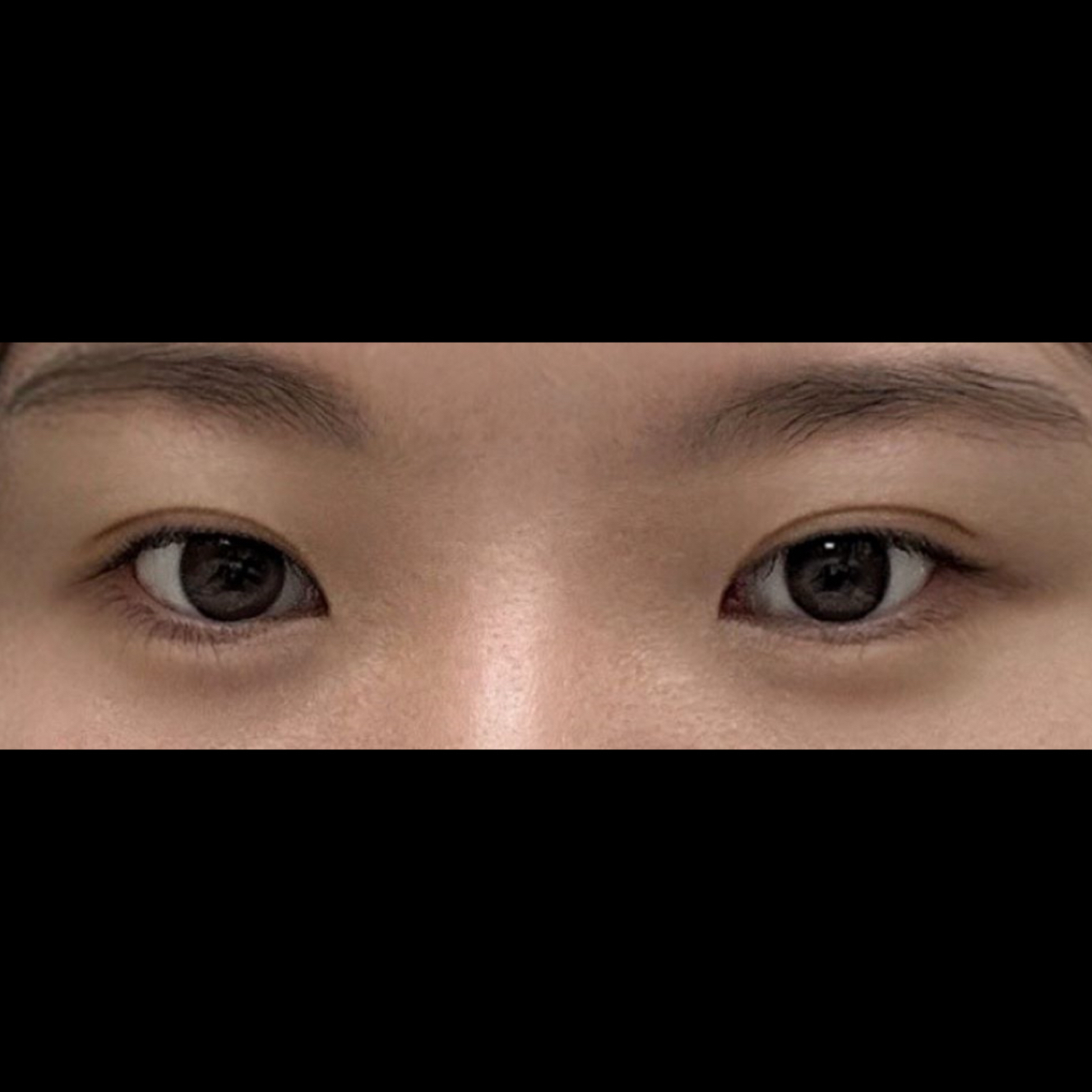 밑트임 후기